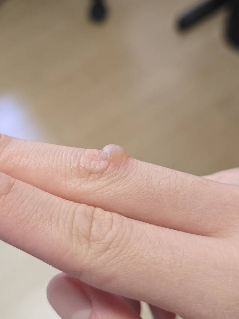 [잡담] 어제 화상입고 물집 생겼는데 터뜨리면 안되려나...? | 인스티즈