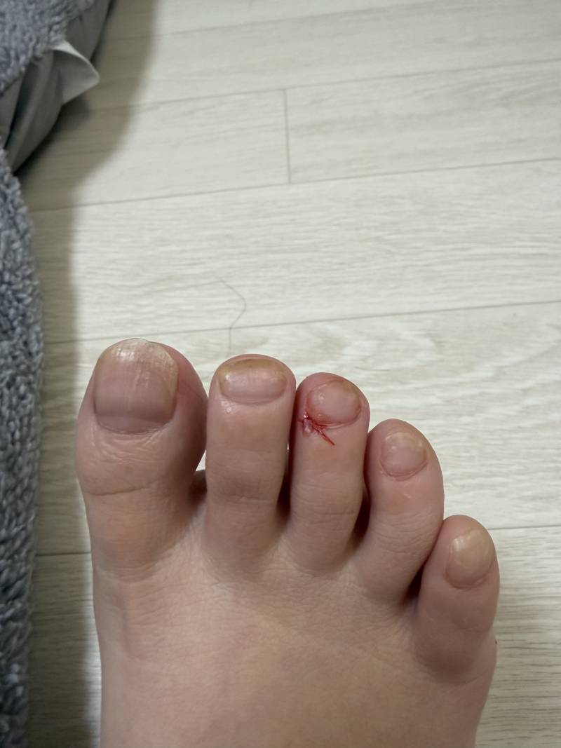 [잡담] 서랍장 열다 찧었는데 심한편이야?? ㅎㅇㅈㅇ | 인스티즈