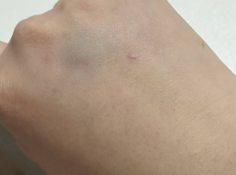 [잡담] 멍들면 부어?? | 인스티즈