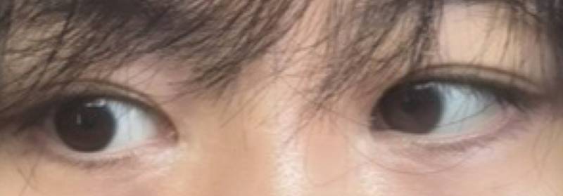 [잡담] 나 쌍수할까 말까 | 인스티즈