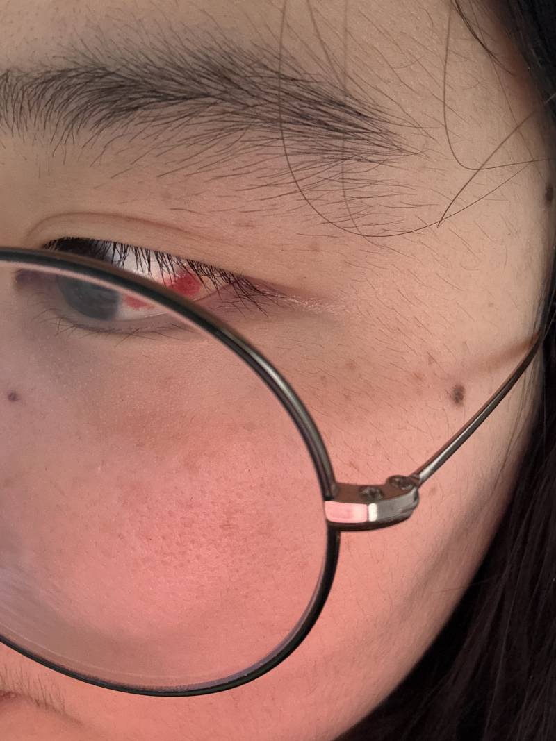 [잡담] 실핏줄로 안과가도됨? | 인스티즈