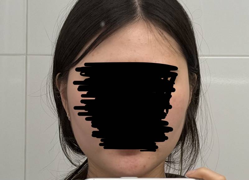 [잡담] 옆볼 필러.. 아무리 봐도 넣는게 좋겠디..? | 인스티즈