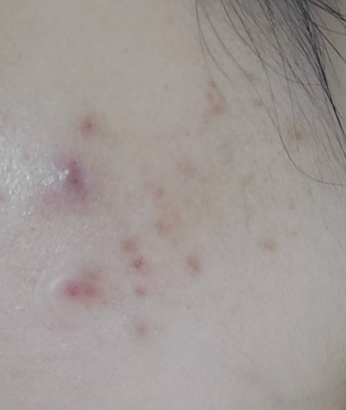 [잡담] 구라안치고 여드름 개많아 피부였는데 싹 없어짐 | 인스티즈