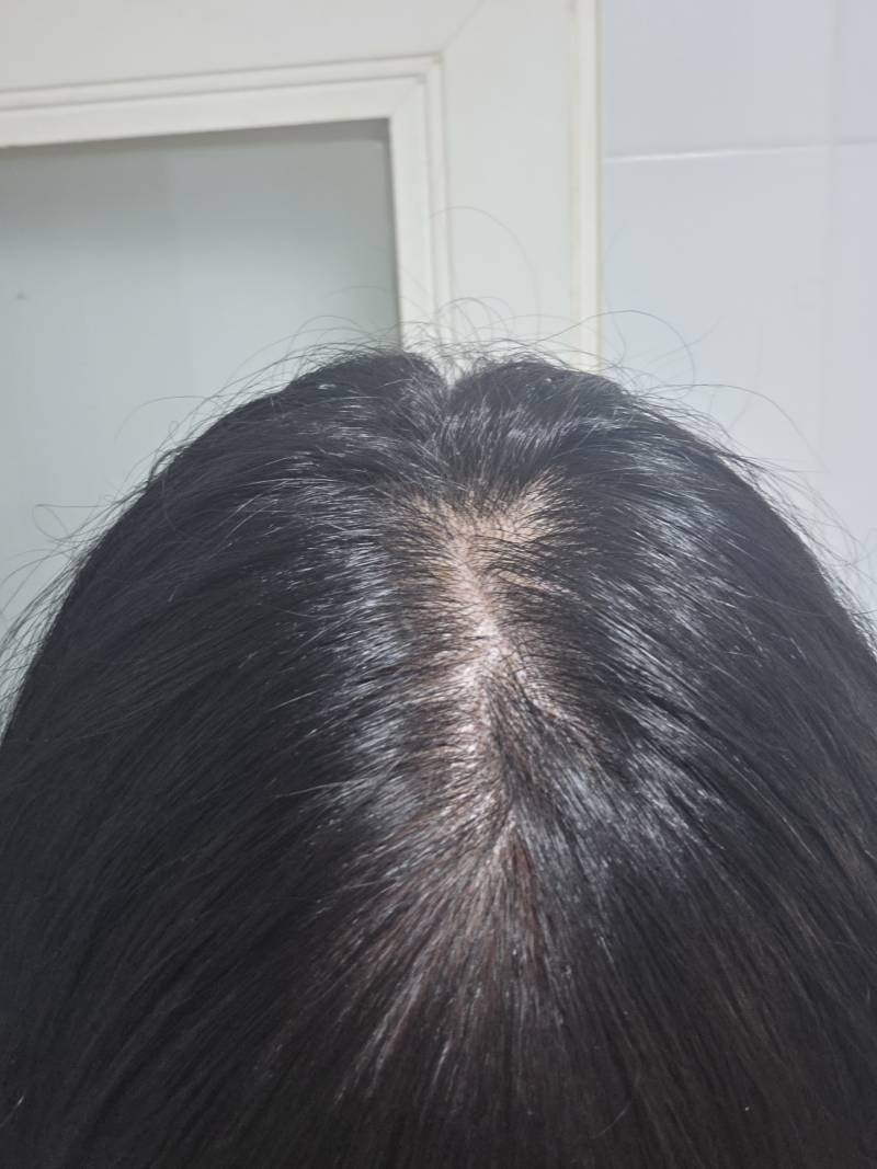 [잡담] 탈모 비포 에프터 봐주라 | 인스티즈