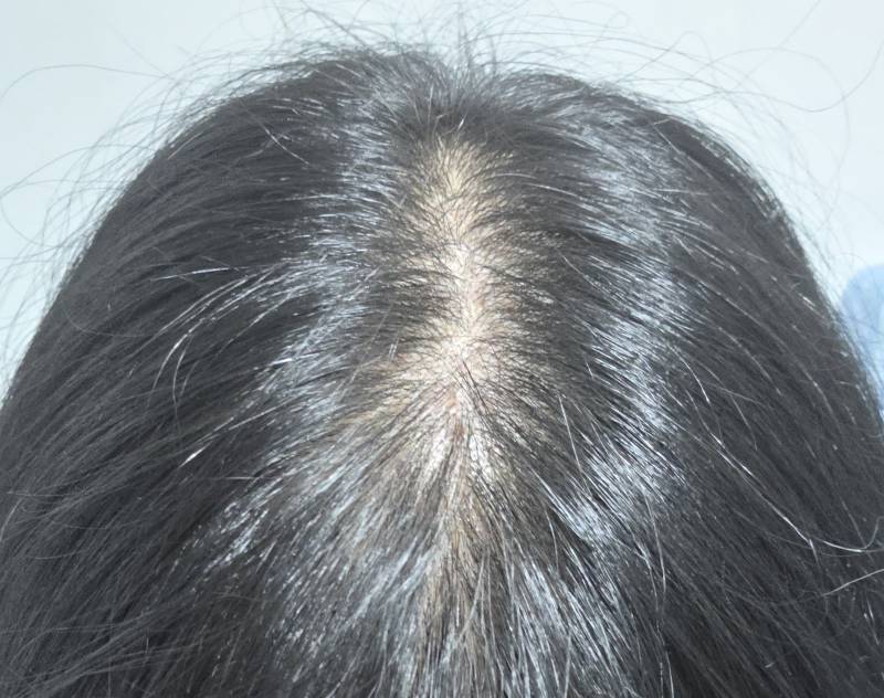 [잡담] 탈모 비포 에프터 봐주라 | 인스티즈