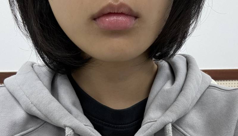 [잡담] 님들아 나 입술 필러좀 봐주셈🙏 | 인스티즈
