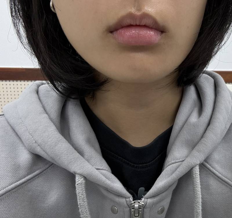 [잡담] 님들아 나 입술 필러좀 봐주셈🙏 | 인스티즈
