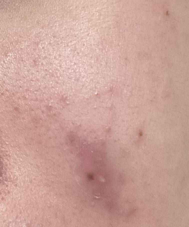 [잡담] 이런건 피부과 가야겠지? | 인스티즈