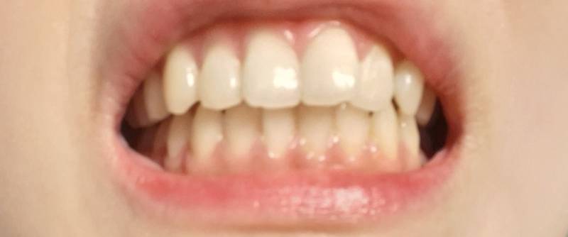 [잡담] 얘들아 나 교정해야되는 수준인지 봐줄수있어?혐오주의 | 인스티즈