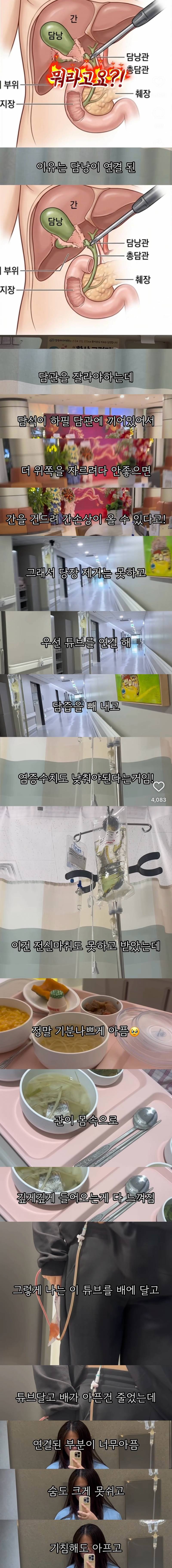 (충격주의) 위고비 마운자로 맞고 배에 구멍..JPG | 인스티즈