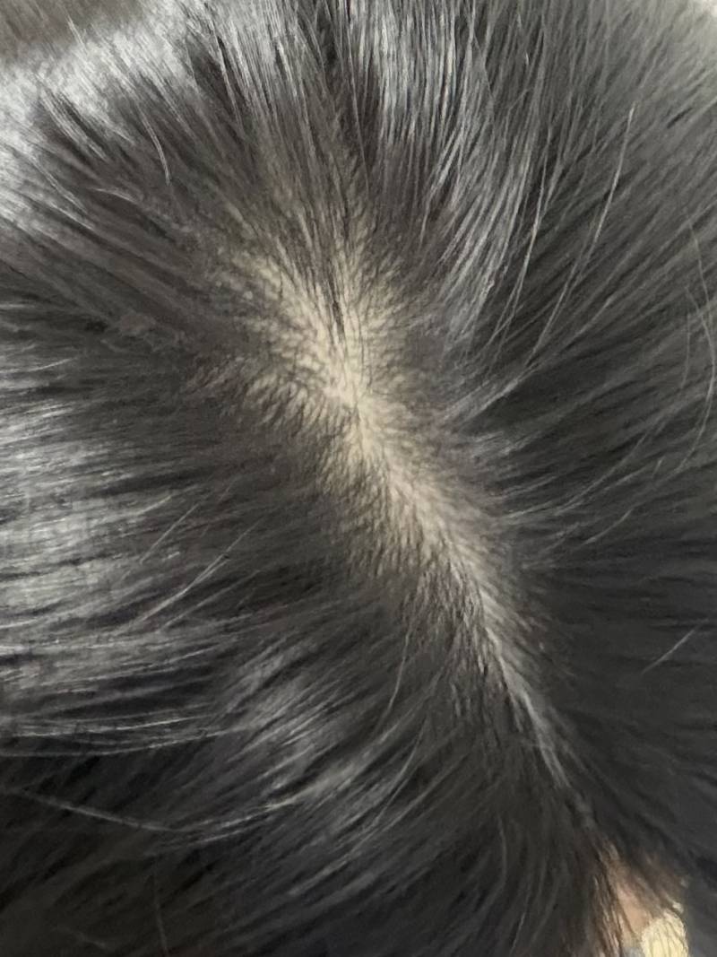 [잡담] 나 탈모같아? | 인스티즈