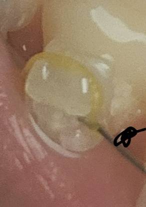 [잡담] 혹시 여기 교정해보거나 치위생사익 있어?40 | 인스티즈