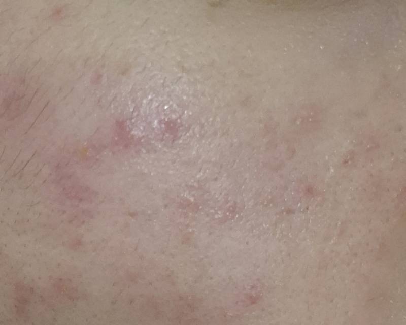 [잡담] ㅎㅇㅈㅇ) 갑자기 피부가 안 좋아졌어 이거 알러진가?? | 인스티즈