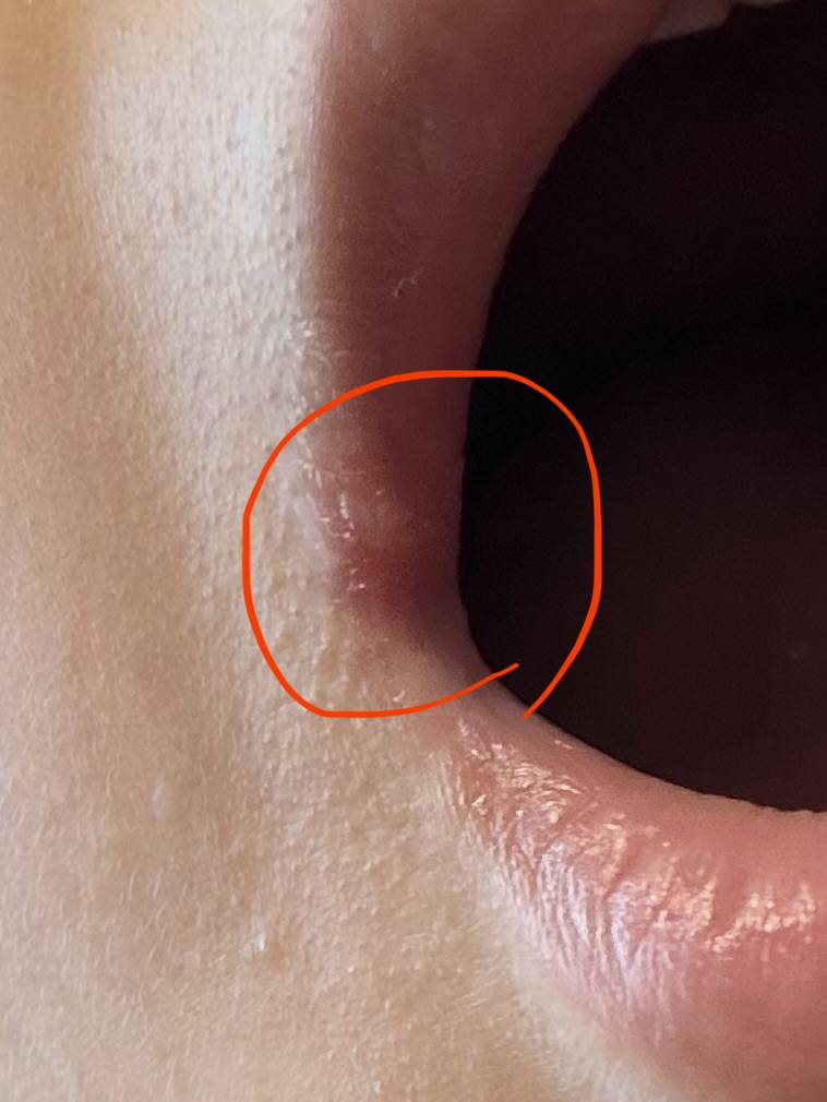 [잡담] ㅎㅇㅈㅇ 익들아 이거 무슨 입병임..? | 인스티즈