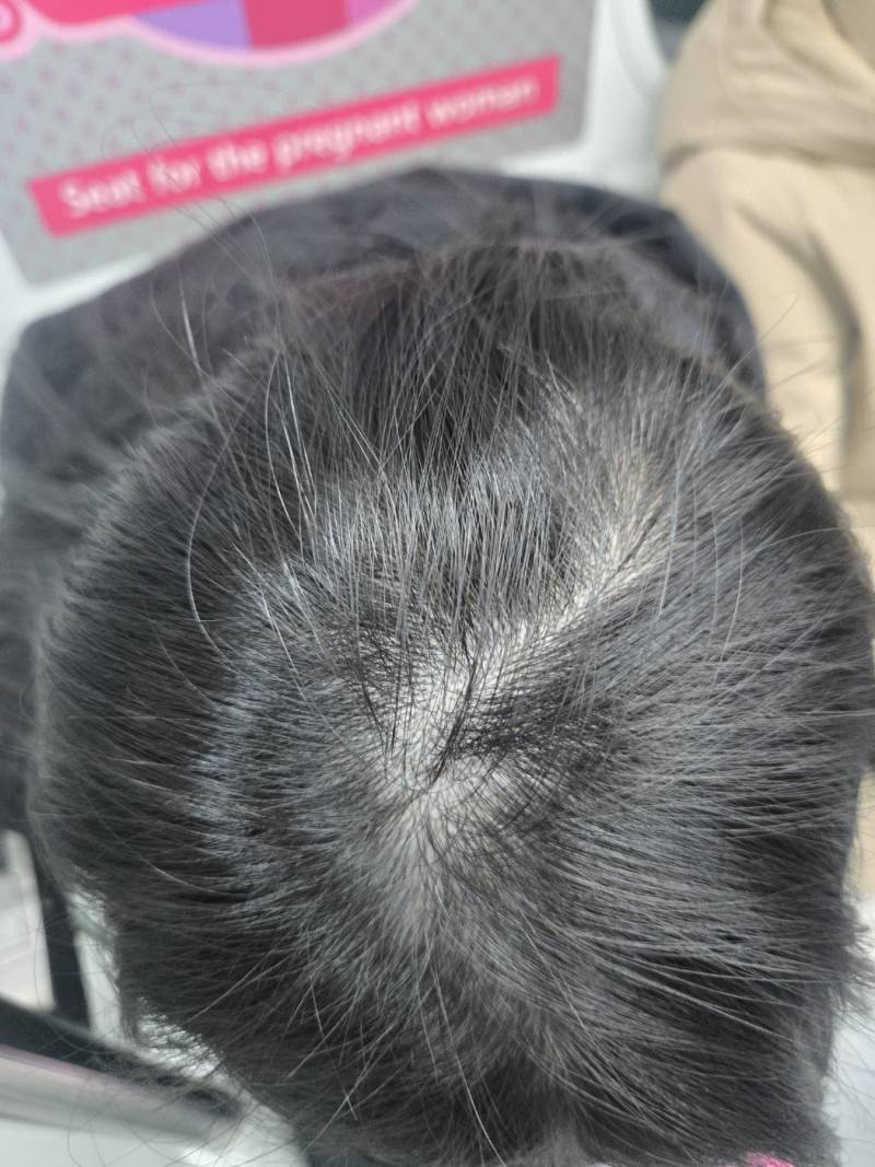 [잡담] 애들아 나 탈모야? | 인스티즈