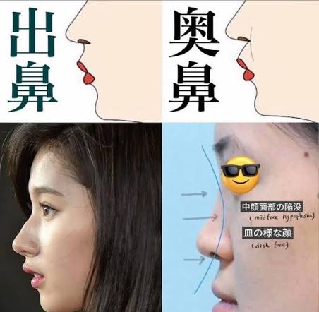 [잡담] 일본에는 중안면부 함몰 정병이라는 게 있대 | 인스티즈