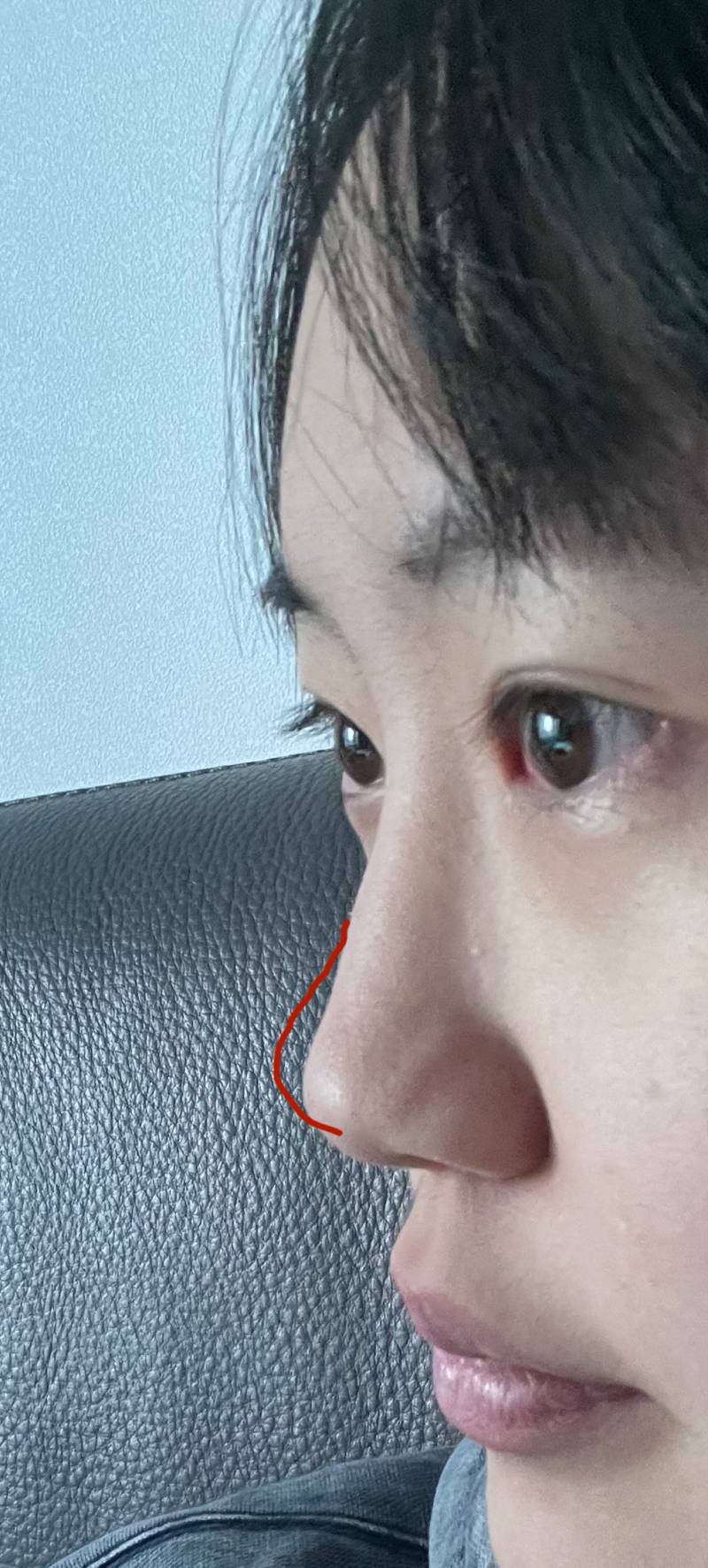 [잡담] 코수술하면 좋겠지?ㅠ | 인스티즈