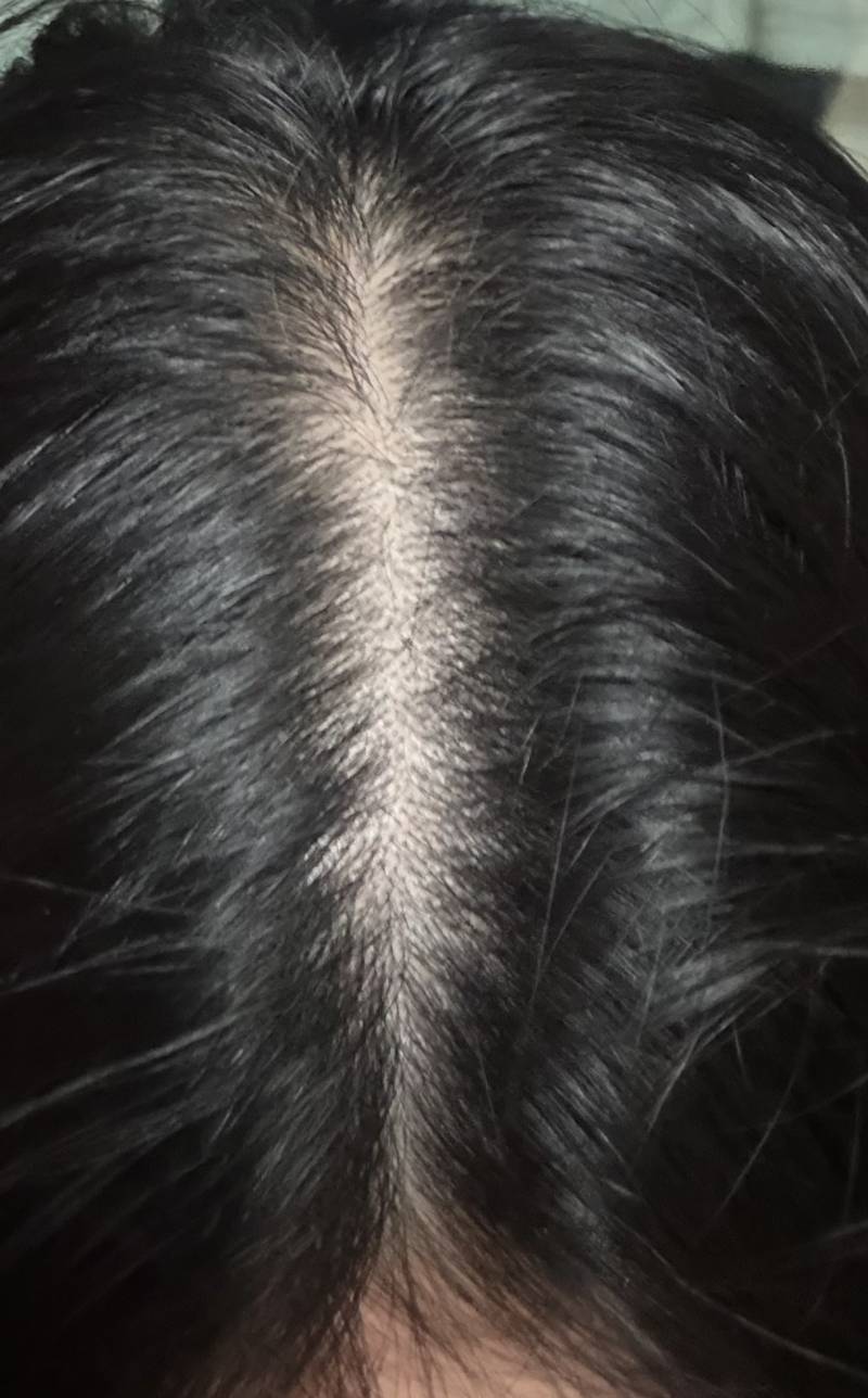 [잡담] 정수리탈모.. 같은데 병원가야겠지? | 인스티즈