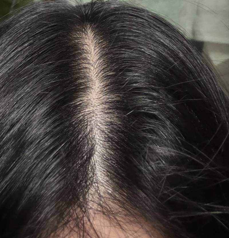 [잡담] 정수리탈모.. 같은데 병원가야겠지? | 인스티즈