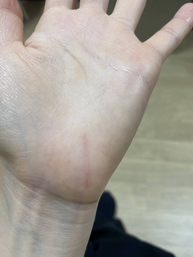 [잡담] 칼에 베인 거 이정도로는 병원 안가도 될까???ㅠ | 인스티즈