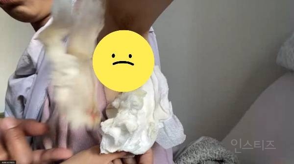 감기로 병원 갔다가 폐 한 쪽 적출 당한 피해자 | 인스티즈