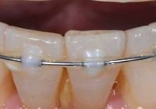 [잡담] 앞니에 이거 치석이야? 사진주의 | 인스티즈