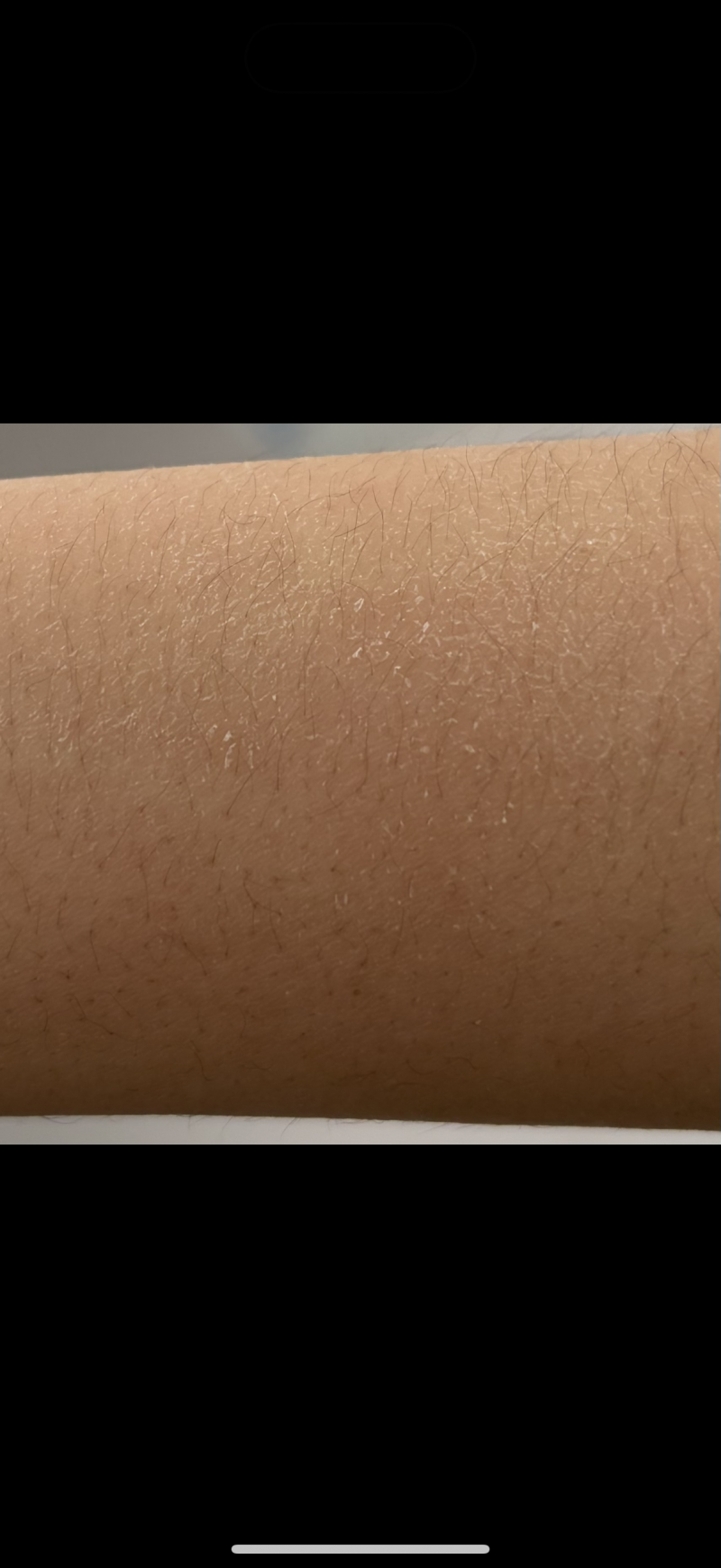 [잡담] 내 팔 좀 봐줄 사람.. 이렇게 각질이 하얗게 뜨는데 이럴땐 어케해 ㅎㅇㅈㅇ | 인스티즈