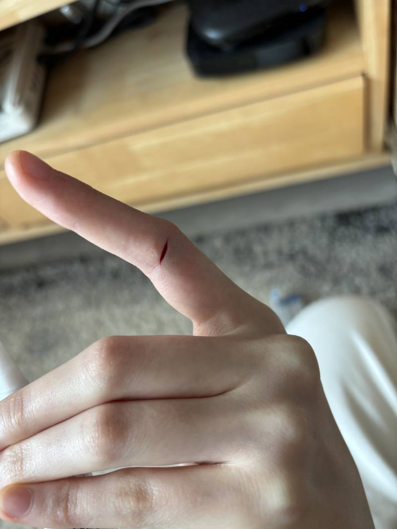 [잡담] (혐주의) 손가락상처 봐줄익.. 병원가야될까? | 인스티즈