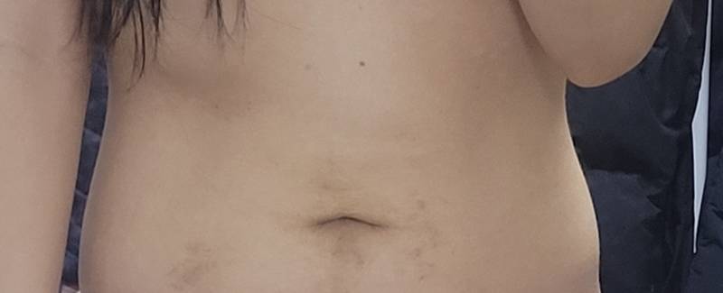 [잡담] 나 배 흉터 심해보여? | 인스티즈