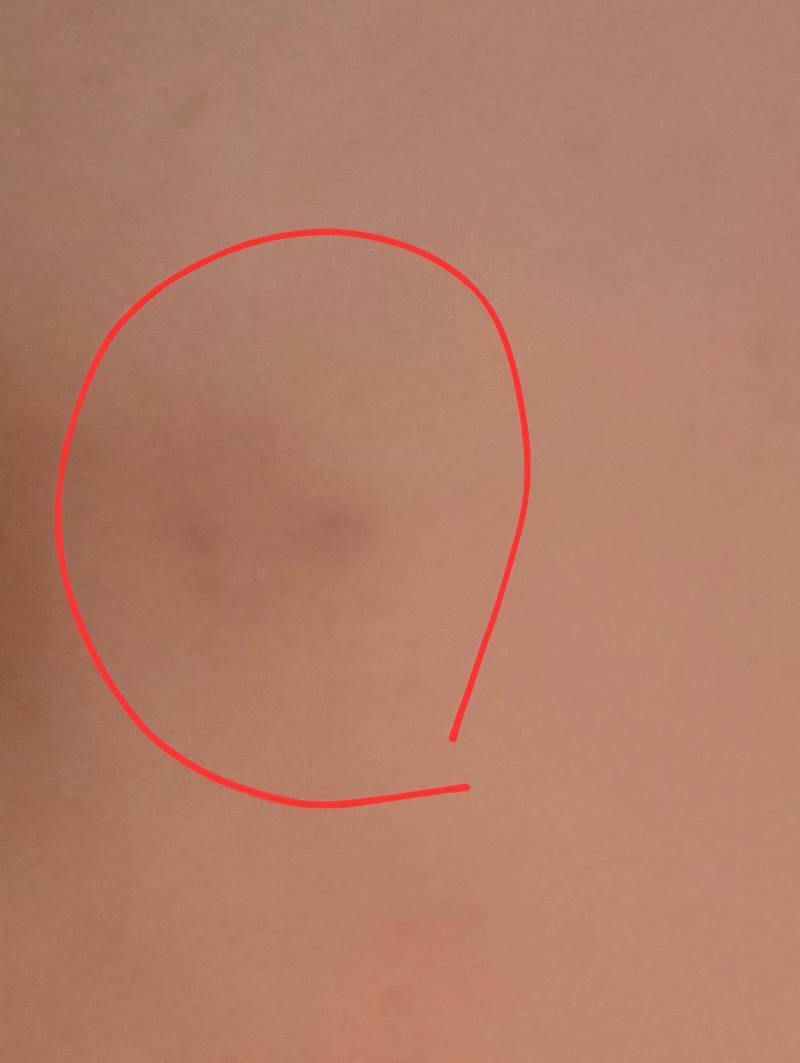 [잡담] 피부에 이런 얼룩 안없어지나... | 인스티즈