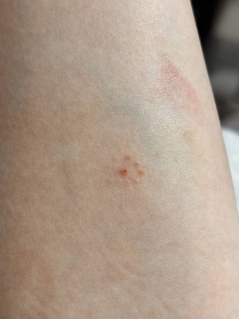 [잡담] 손목 아래쪽 팔에 뭐 이상한게 났어 | 인스티즈