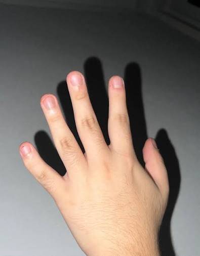 [잡담] 단풍손인데 손톱만 예쁨 vs 손 모델급 그치만 손톱 1cm | 인스티즈
