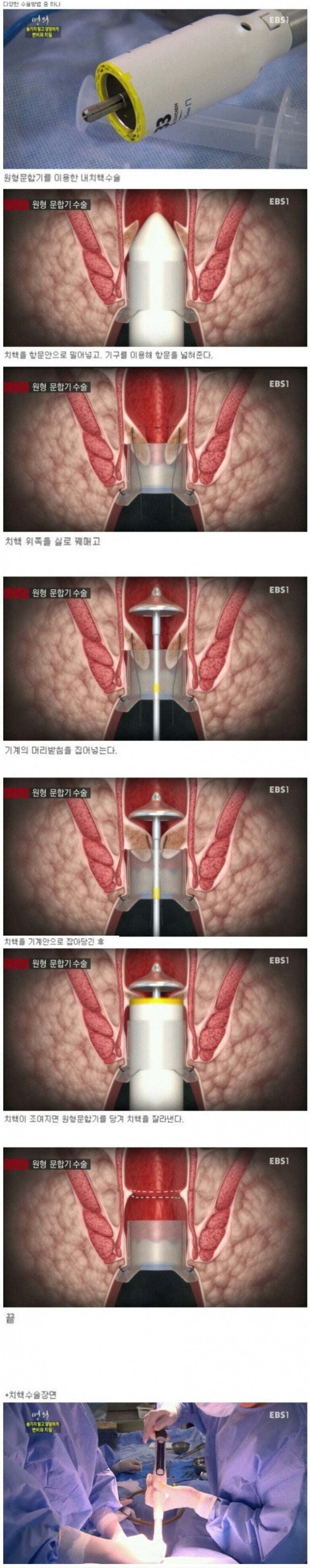 치질 수술 기계.JPG | 인스티즈