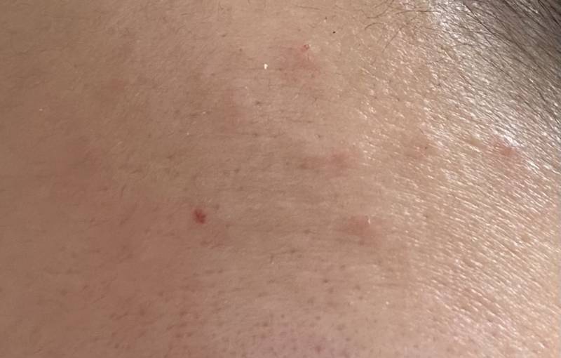 [잡담] 갑자기 이마에 우둘투둘 올라왔는데ㅠㅠ 여드름인가...? | 인스티즈