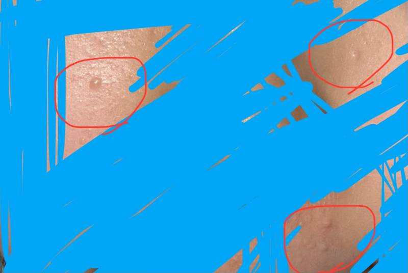 [잡담] ㅎㅇㅈㅇ 익들아 이런거 다 편평사마귀임? | 인스티즈