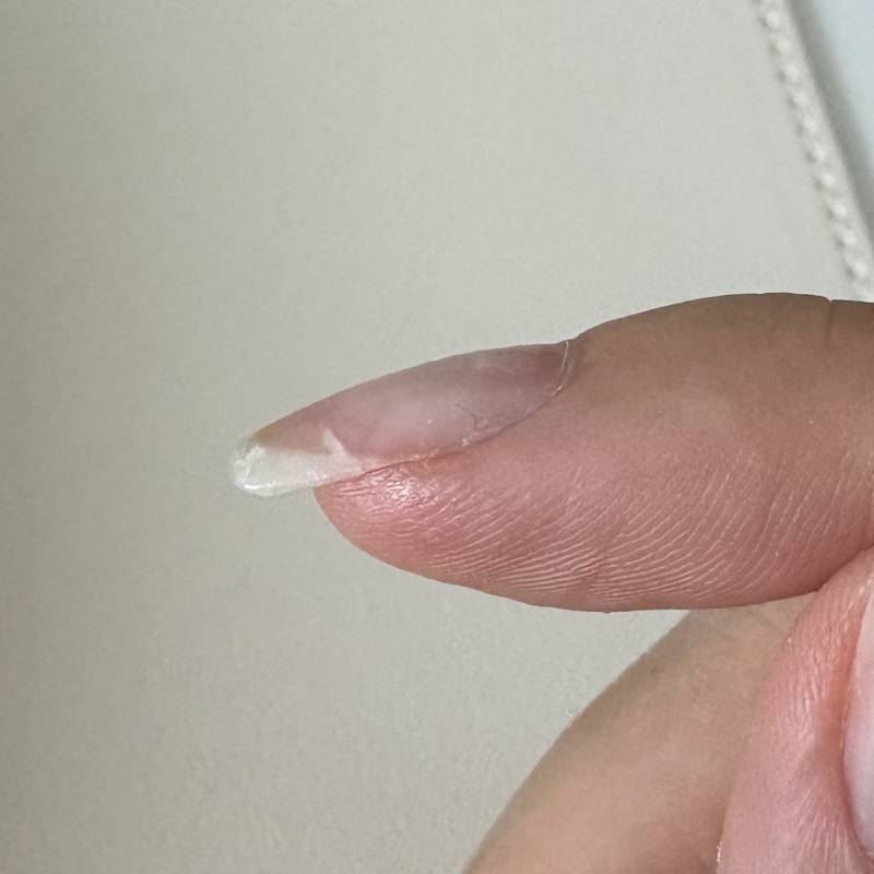 [잡담] 손톱 이렇게 부러졌을때 어떻게 해야 돼??? | 인스티즈
