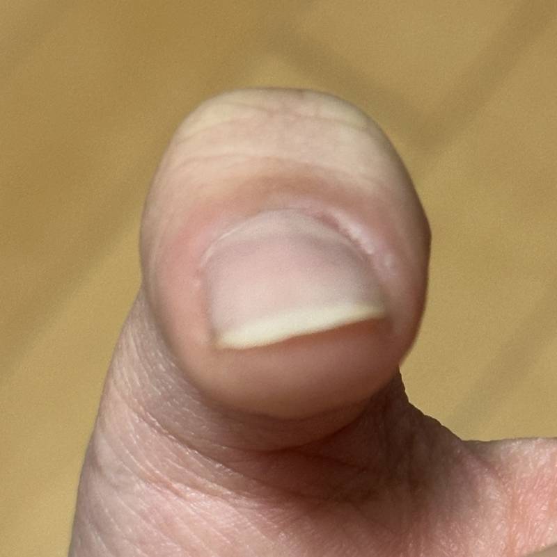 [잡담] 나처럼 엄지손톱 틀어진 익 있어? | 인스티즈