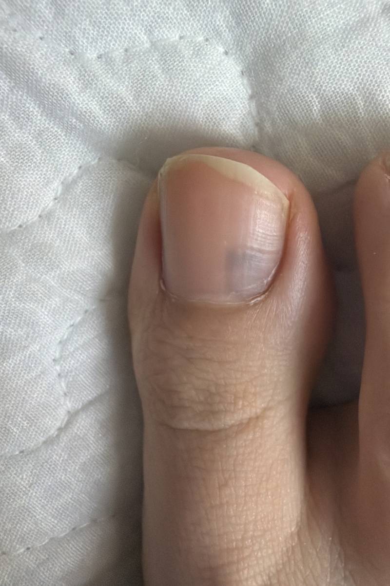 [잡담] 발톱 멍든것같은데 알아서 사라지겠지? | 인스티즈