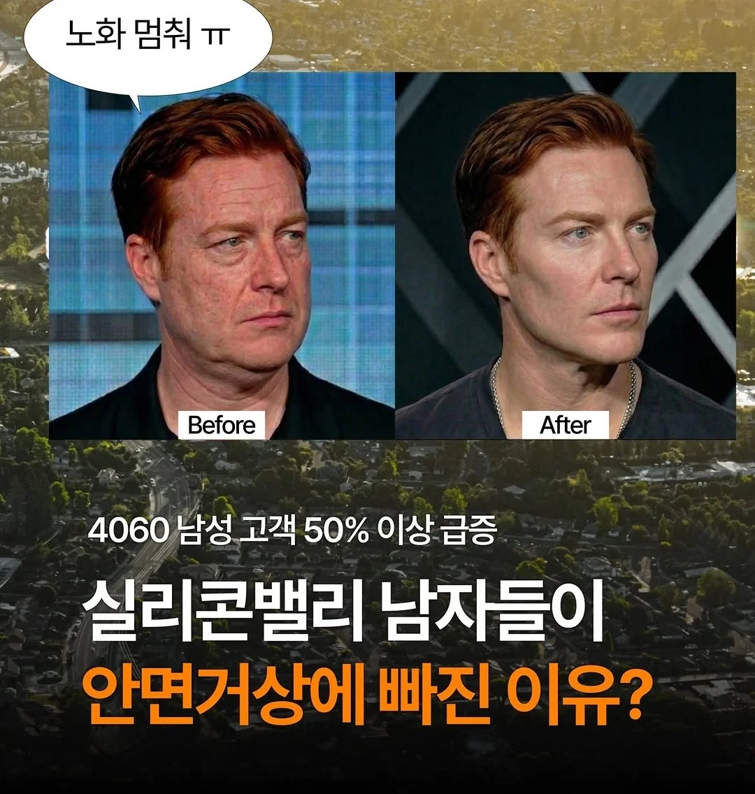 요즘 4050남 까지 휩쓸고있는 미용 시술..JPG | 인스티즈