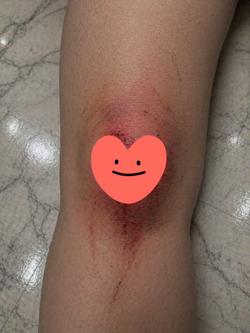[잡담] 경기 안 풀린다고 술 먹고 역전에 뛰다가 넘어져서 무릎까짐 | 인스티즈