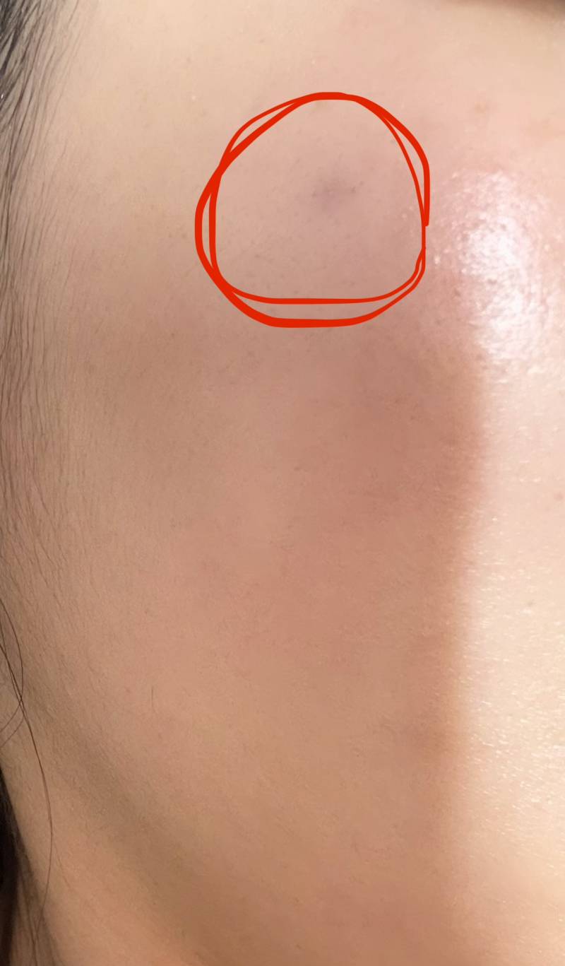 [잡담] 이거 피지낭종이야 뭐야 ..? | 인스티즈
