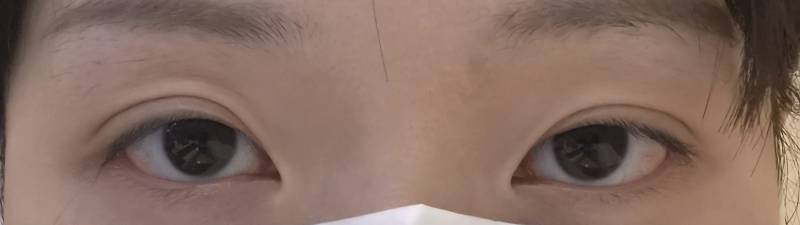 [잡담] 쌍수 다시 할 건데 인아웃 할까 세미 아웃 할까?? | 인스티즈