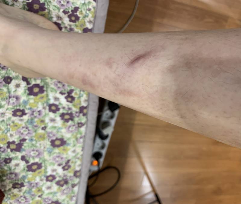 [잡담] 흉터 이정도면 흉터연고 전체적으로 바를거야? 진한 부분에만 바를거야? | 인스티즈