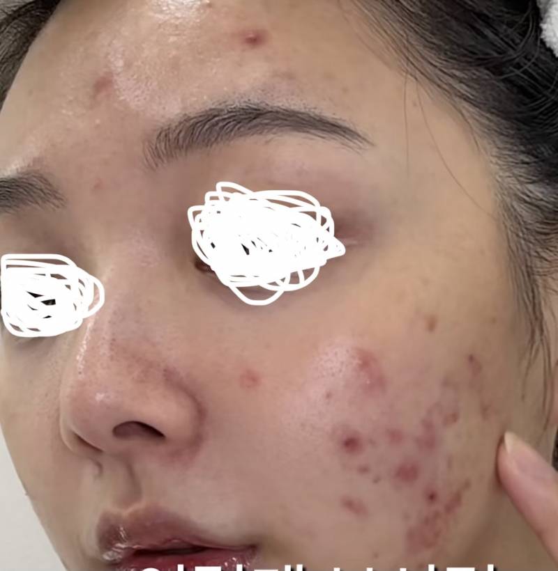 [잡담] 내 피부가 지금 이런데 뭘 해야할까 | 인스티즈