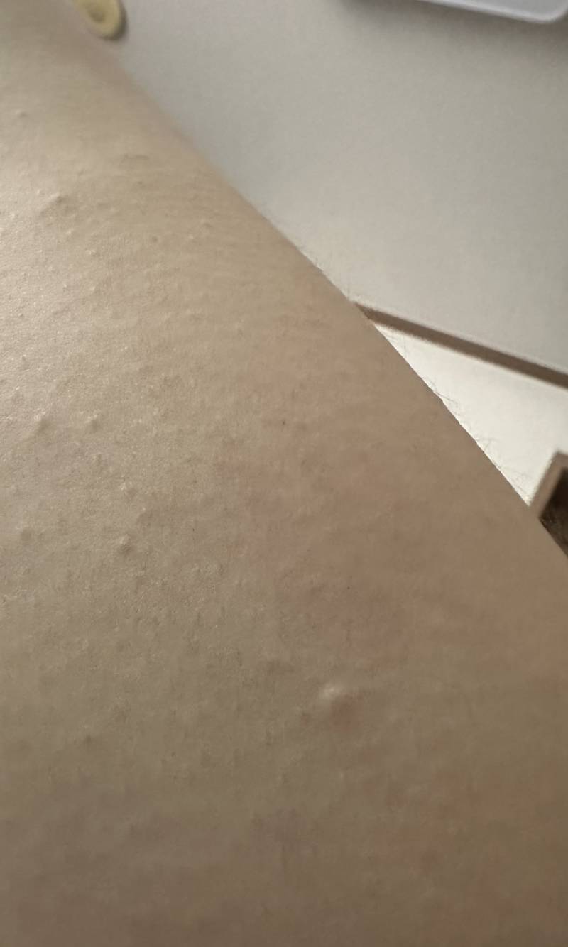 [잡담] 가끔 팔이랑 등이랑 가려워서 보면 이런거 나는데 뭔지알아? | 인스티즈