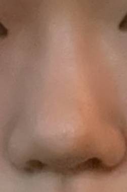 [잡담] 난 코수술 하고 자존감이 진짜 달라짐 | 인스티즈