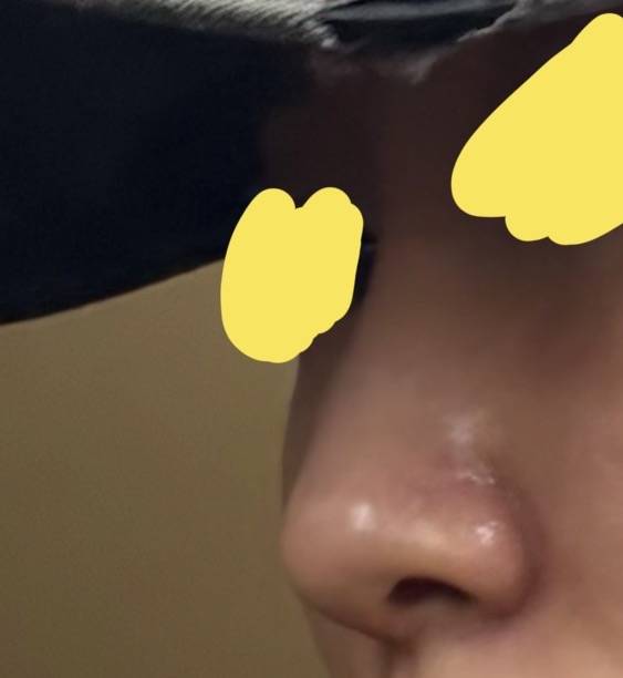 [잡담] 한ㅎㅈ 코 성형으로 될까? | 인스티즈