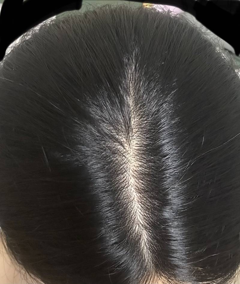[잡담] 나 탈모같아? | 인스티즈