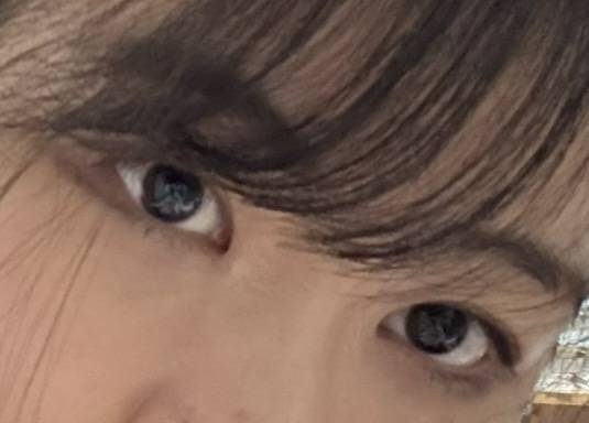 [잡담] 눈성형 상담좀 해주라 (눈매교정vs눈꼬리올리기) | 인스티즈