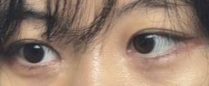 [잡담] 눈성형 상담좀 해주라 (눈매교정vs눈꼬리올리기) | 인스티즈